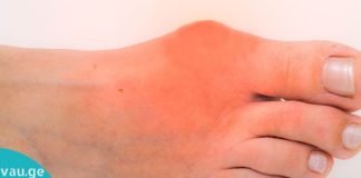 პოდაგრას მკურნალობა: აი როგორ გავთავისუფლდეთ მისგან