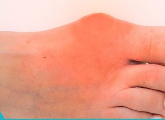 პოდაგრას მკურნალობა: აი როგორ გავთავისუფლდეთ მისგან