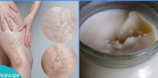 საოცარი მალამო ვარიკოზულ ვენებთან საბრძოლველად