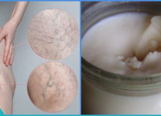 საოცარი მალამო ვარიკოზულ ვენებთან საბრძოლველად