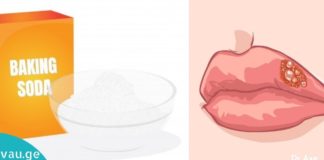 ჰერპესის მკურნალობა სახლის პირობებში