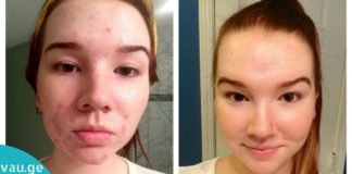 დაიღალეთ აკნესთან ბრძოლით? მაშინ სცადეთ ეს მეთოდი!