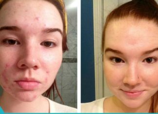 დაიღალეთ აკნესთან ბრძოლით? მაშინ სცადეთ ეს მეთოდი!