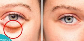 ეფექტური მეთოდები, როგორ მოვიცილოთ თვალის ქვეშ უსიამოვნო “ბალიშები