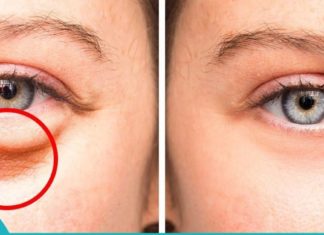 ეფექტური მეთოდები, როგორ მოვიცილოთ თვალის ქვეშ უსიამოვნო “ბალიშები