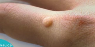 მეჭეჭები საკმაოდ შემაწუხებელი და პრობლემურია. აი ამ მარტივი მეთოდებით შეგიძლიათ მოიცილოთ სამუდამოდ