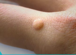 მეჭეჭები საკმაოდ შემაწუხებელი და პრობლემურია. აი ამ მარტივი მეთოდებით შეგიძლიათ მოიცილოთ სამუდამოდ