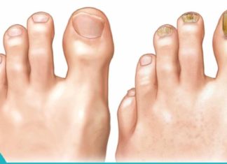 სოკოს აუტანელი დაავადება აღარ შეგაწუხებთ თუ ამ მეთოდებს ცდით