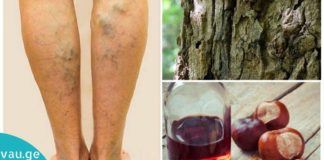 გტანჯავთ ვარიკოზული ვენები და არ იცით როგორ იმკურნალოთ? ხალხური მედიცინა დაგეხმარებათ ამ ტკივილის სამუდამოდ მოხსნაში