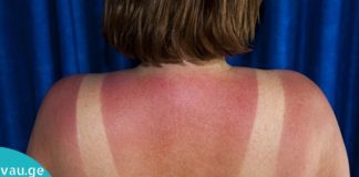 მზისგან დამწვარი კანის მოვლა სახლის პირობებში.