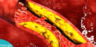 ქოლესტერინის დაწევა ხალხური მეთოდებით