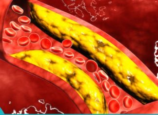 ქოლესტერინის დაწევა ხალხური მეთოდებით