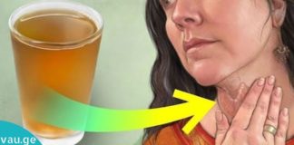 ჩიყვის ეფექტური სამკურნალო მეთოდები ხალხური მედიცინისგან