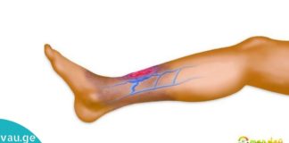 ცუდი ცირკულაციის ნიშნები და ეფექტური რჩევები როგორ მოგვარდეს სისხლში ეს პრობლემა