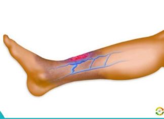 ცუდი ცირკულაციის ნიშნები და ეფექტური რჩევები როგორ მოგვარდეს სისხლში ეს პრობლემა