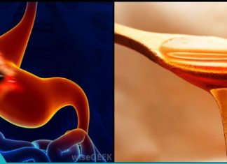 გასტრიტის მკურნალობა თაფლით