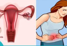 საკვერცხის კისტას მკურნალობა უნიკალური მეთოდით