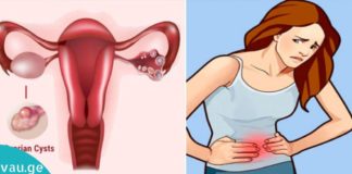 საკვერცხის კისტას მკურნალობა უნიკალური მეთოდით