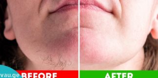 გასაოცარი მეთოდები არასასურველი თმების მოსაცილებლად სახლის პირობებში