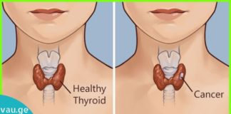 ამ მეთოდებით ფარისებრი ჯირკვლის მკურნალობა იაფი და ეფექტურია