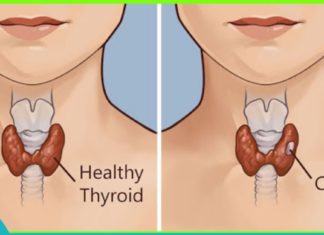ამ მეთოდებით ფარისებრი ჯირკვლის მკურნალობა იაფი და ეფექტურია