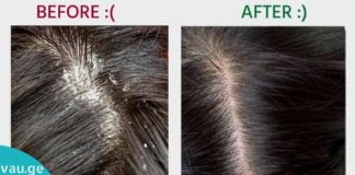 ქერტლის მკურნალობა სახლის პირობებში ხალხური მედიცინით