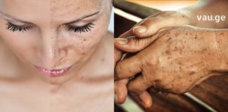 პიგმენტური ლაქების მოსაშორებელი ოთხი ყველაზე კარგი ნიღაბი პროფესიონალი კოსმეტოლოგისგან!