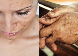 პიგმენტური ლაქების მოსაშორებელი ოთხი ყველაზე კარგი ნიღაბი პროფესიონალი კოსმეტოლოგისგან!