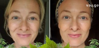 ჭინჭრის ზეთი შესანიშნავი სამკურნალო საშუალებაა ნაოჭების, ქერტლისა და თმის ცვენის საწინააღმდეგოდ.