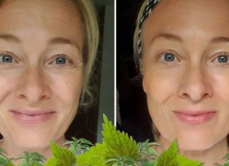 ჭინჭრის ზეთი შესანიშნავი სამკურნალო საშუალებაა ნაოჭების, ქერტლისა და თმის ცვენის საწინააღმდეგოდ.