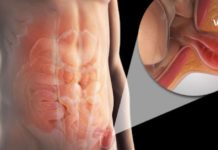 თიაქარის სამკურნალო მალამო მოამზადეთ სახლში