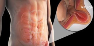 თიაქარის სამკურნალო მალამო მოამზადეთ სახლში