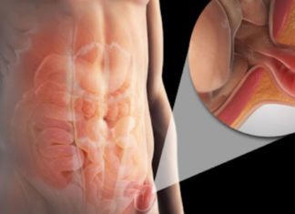 თიაქარის სამკურნალო მალამო მოამზადეთ სახლში