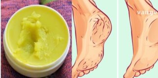 დამსკდარი ქუსლების აღდგენა შესანიშნავი სახლში დამზადებული მალამოთი