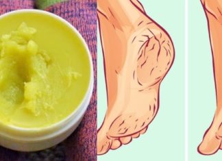 დამსკდარი ქუსლების აღდგენა შესანიშნავი სახლში დამზადებული მალამოთი