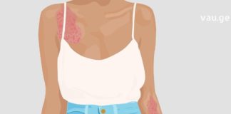 ფსორიაზის დამარცხების მეთოდები მათგან, ვინც უკვე გაუმკლავდა