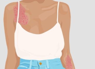 ფსორიაზის დამარცხების მეთოდები მათგან, ვინც უკვე გაუმკლავდა