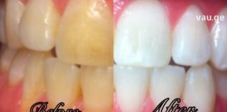 კბილების გათეთრების ბუნებრივი გზები!