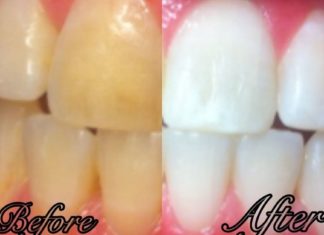 კბილების გათეთრების ბუნებრივი გზები!