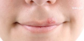 ტუჩზე ჰერპესი მოიცილეთ უმოკლეს დროში ხალხური მეთოდებით