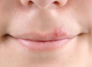 ტუჩზე ჰერპესი მოიცილეთ უმოკლეს დროში ხალხური მეთოდებით