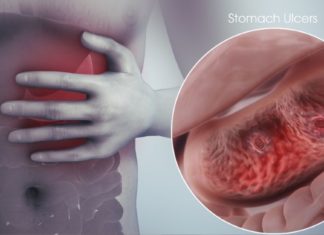 ხალხური მედიცინა გთავაზობთ კუჭის წყლულის სამკურნალო რეცეფტებს