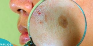 სუპერმეთოდი!! პიგმენტური ლაქების მოცილება სახლის პირობებში.