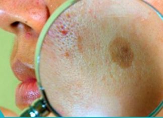 სუპერმეთოდი!! პიგმენტური ლაქების მოცილება სახლის პირობებში.