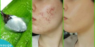 ორი ინგრედიენტით დამზადებული გელი: მკურნალობს ასაკობრივ ლაქებს, ნაწიბურებს, აკნეს, ფსორიაზს და დამწვრობას.