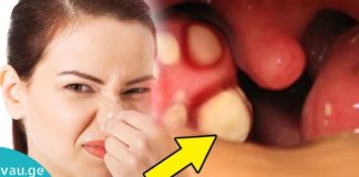 Მოიცილეთ კბილებზე ნადები, ქვები და ბაქტერიები, რომლებიც იწვევს პირის ღრუს არასასურველ სუნს, სულ რაღაც ერთი ინგრედიენტის დახმარებით!