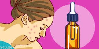 ზეთი, რომელიც მკურნალობს ფსორიაზს, ჰერპესს და კიდევ უფრო ბევრ დაავადებას!