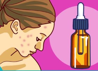 ზეთი, რომელიც მკურნალობს  ფსორიაზს, ჰერპესს და კიდევ უფრო ბევრ დაავადებას!