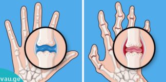 მოიცილეთ ართრიტით გამოწვეული ხელის აუტანელი ტკივილი.