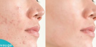 ნაწიბურების მოცილება სახლის პირობებში